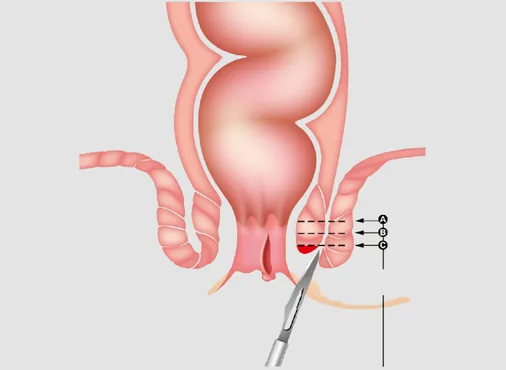 Fissure Surgery - Lateral Internal Sphincterotomy (LIS) consultation at Niraaya Hospital